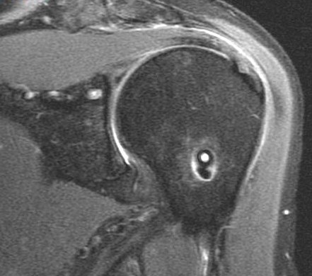 Figure 1 for case Tear of tendon of long head of biceps brachii sp tenodesis (RID1944)